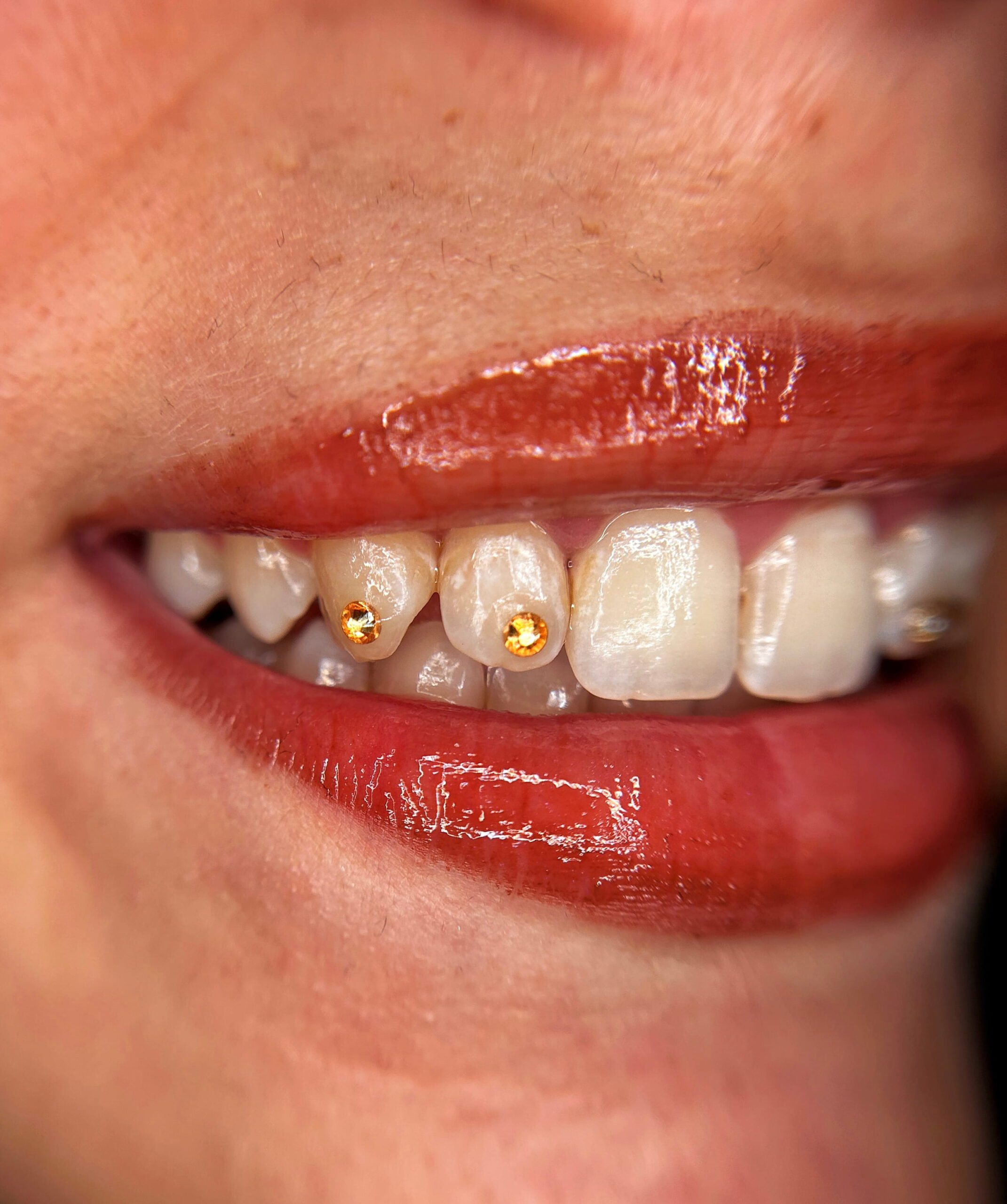 Resultado gema dental
